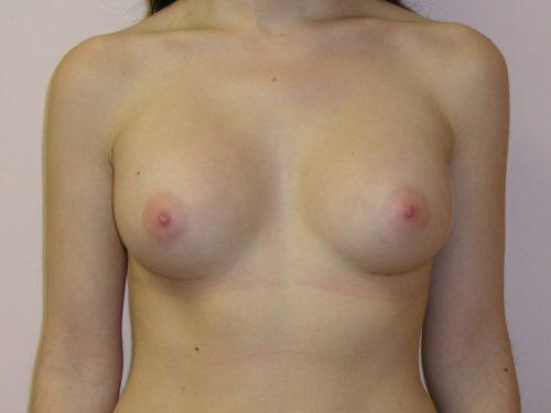 Breast Augmentation  Before & After Image