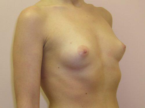 Breast Augmentation  Before & After Image