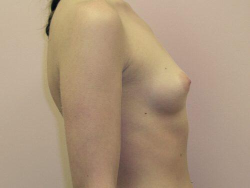 Breast Augmentation  Before & After Image