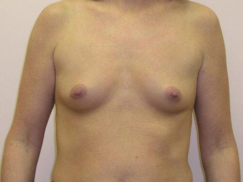 Breast Augmentation  Before & After Image