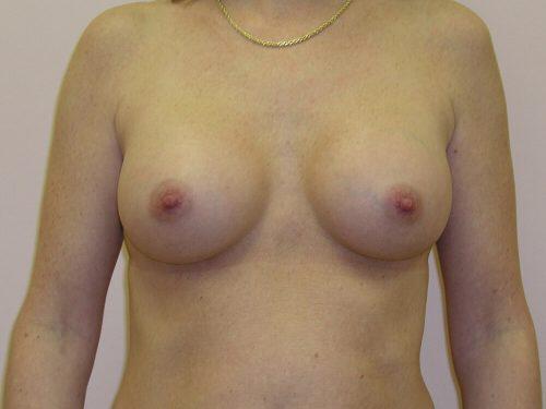 Breast Augmentation  Before & After Image