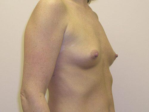 Breast Augmentation  Before & After Image