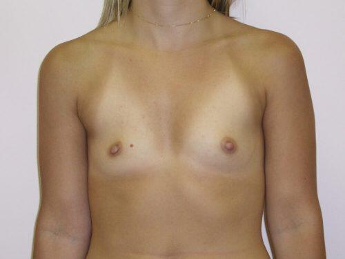 Breast Augmentation  Before & After Image