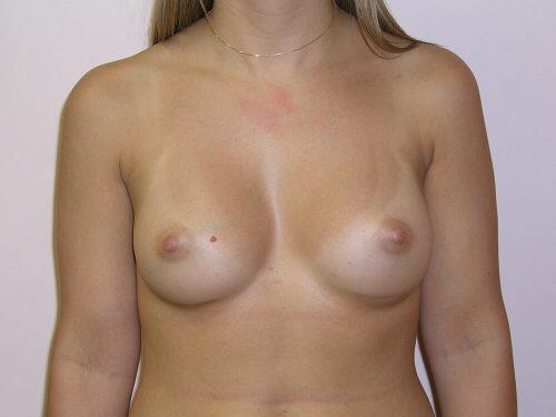 Breast Augmentation  Before & After Image