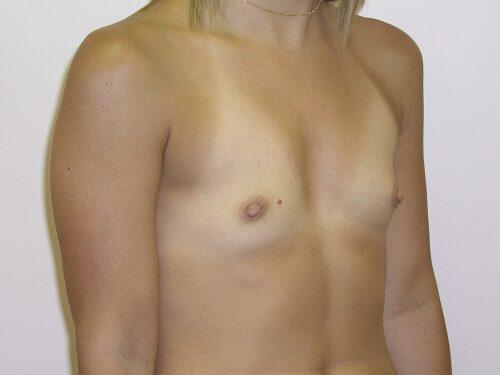 Breast Augmentation  Before & After Image