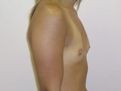 Breast Augmentation  Before & After Image