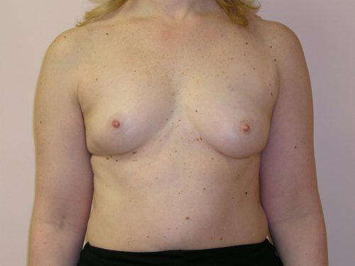 Breast Augmentation  Before & After Image