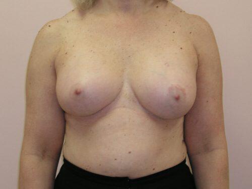 Breast Augmentation  Before & After Image