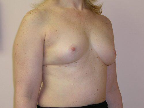 Breast Augmentation  Before & After Image