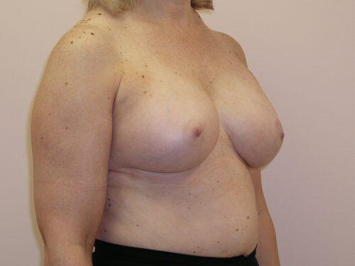 Breast Augmentation  Before & After Image