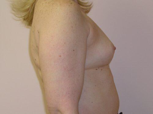 Breast Augmentation  Before & After Image