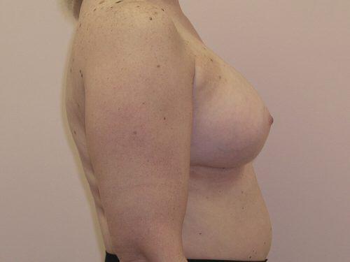 Breast Augmentation  Before & After Image