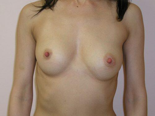 Breast Augmentation  Before & After Image