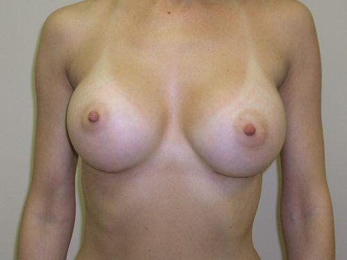 Breast Augmentation  Before & After Image