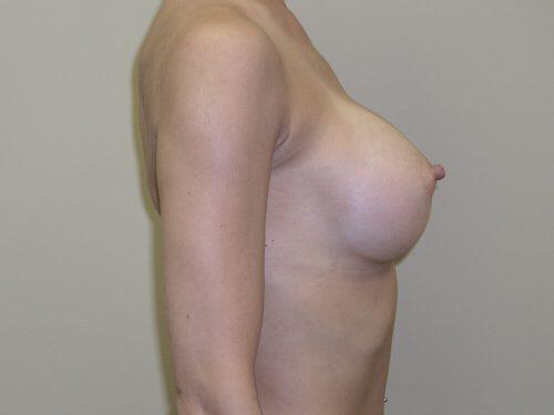 Breast Augmentation  Before & After Image