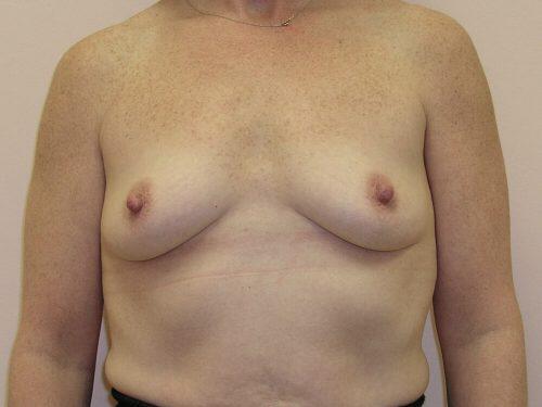 Breast Augmentation  Before & After Image