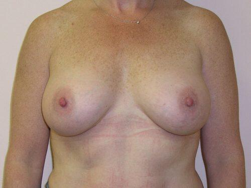 Breast Augmentation  Before & After Image