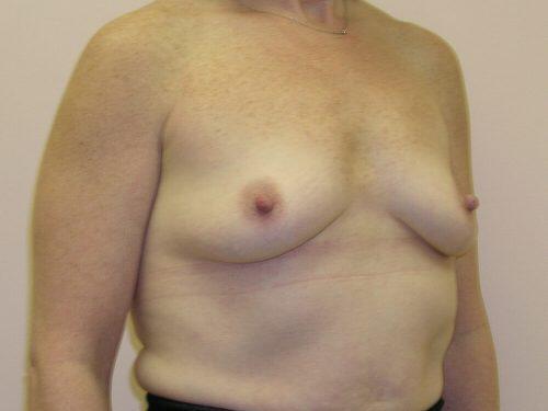 Breast Augmentation  Before & After Image