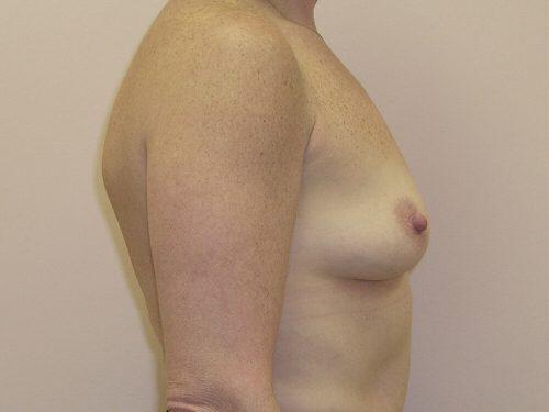 Breast Augmentation  Before & After Image