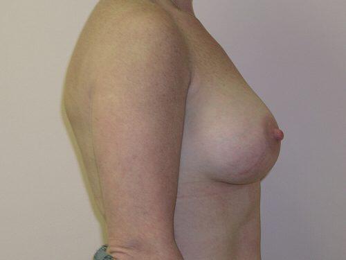 Breast Augmentation  Before & After Image