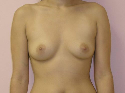 Breast Augmentation  Before & After Image