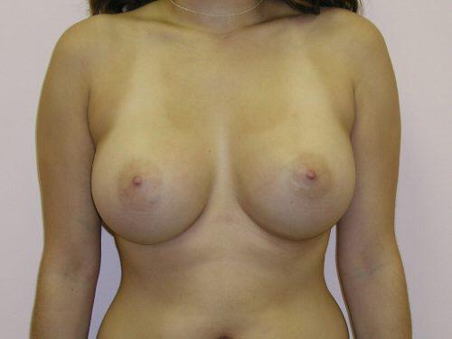 Breast Augmentation  Before & After Image