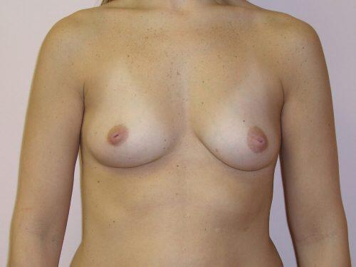 Breast Augmentation  Before & After Image