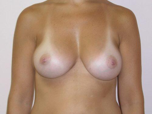 Breast Augmentation  Before & After Image