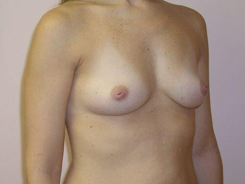 Breast Augmentation  Before & After Image