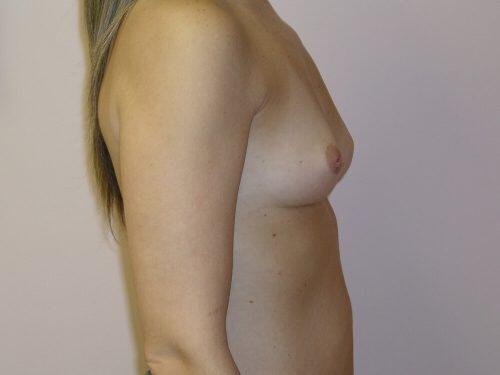 Breast Augmentation  Before & After Image