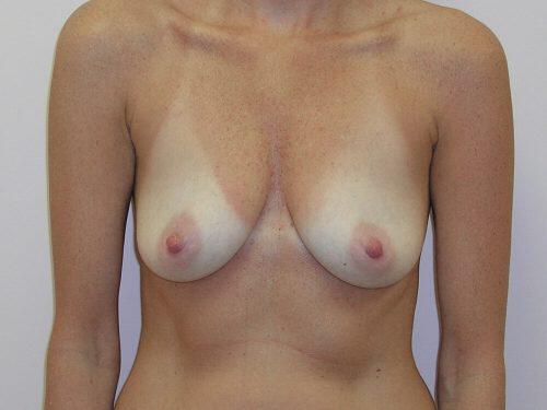 Breast Augmentation  Before & After Image