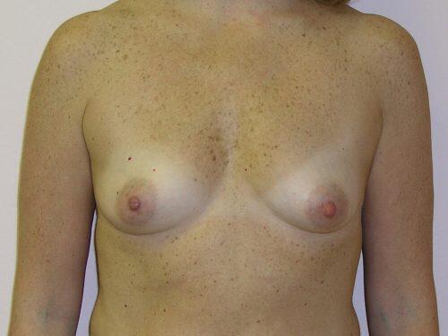 Breast Augmentation  Before & After Image