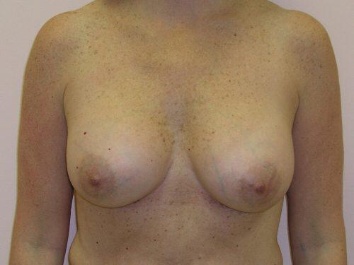 Breast Augmentation  Before & After Image