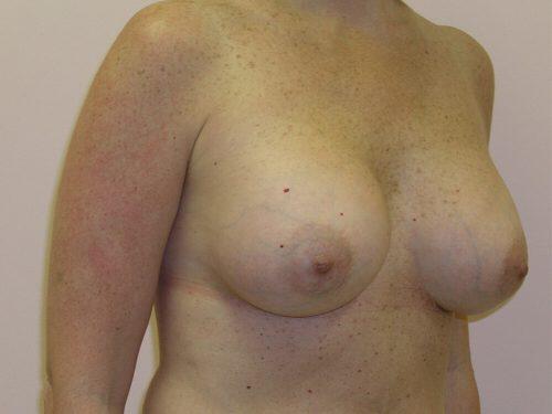 Breast Augmentation  Before & After Image