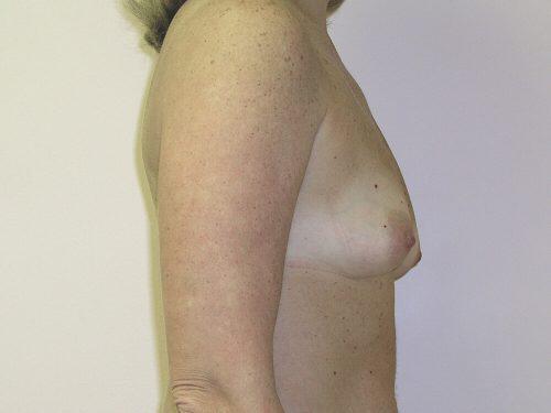 Breast Augmentation  Before & After Image