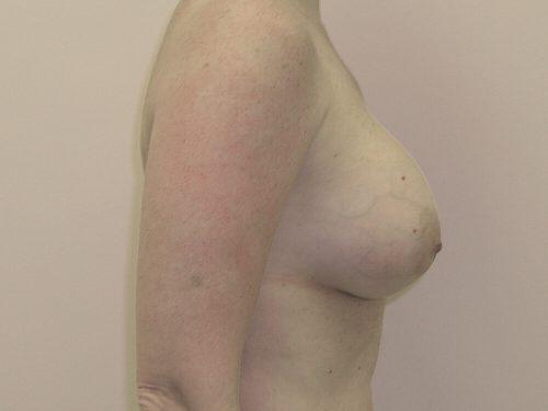 Breast Augmentation  Before & After Image