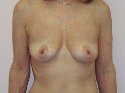 Breast Augmentation  Before & After Image