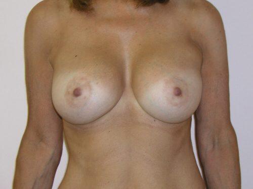 Breast Augmentation  Before & After Image