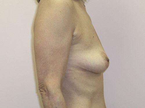 Breast Augmentation  Before & After Image