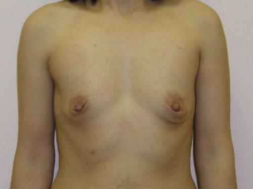 Breast Augmentation  Before & After Image