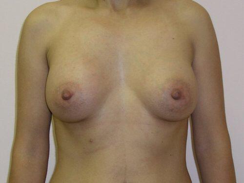 Breast Augmentation  Before & After Image