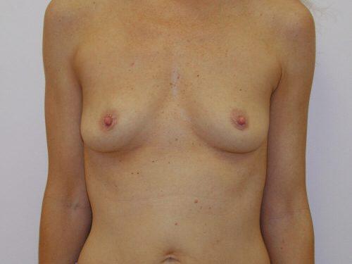 Breast Augmentation  Before & After Image