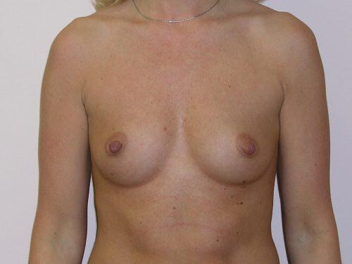 Breast Augmentation  Before & After Image