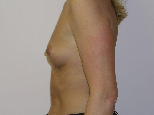 Breast Augmentation  Before & After Image