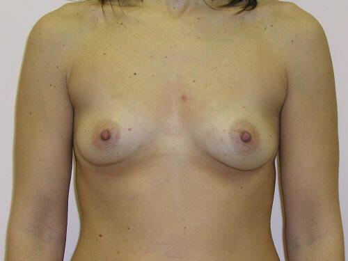 Breast Augmentation  Before & After Image