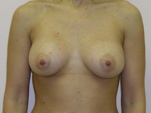 Breast Augmentation  Before & After Image