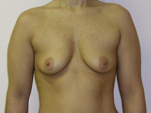 Breast Augmentation  Before & After Image