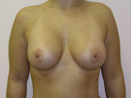 Breast Augmentation  Before & After Image