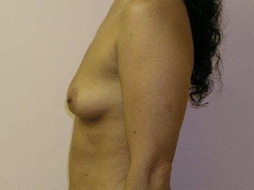 Breast Augmentation  Before & After Image