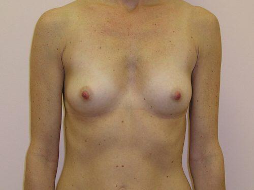 Breast Augmentation  Before & After Image